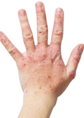 atopic-dermatitis-eczema